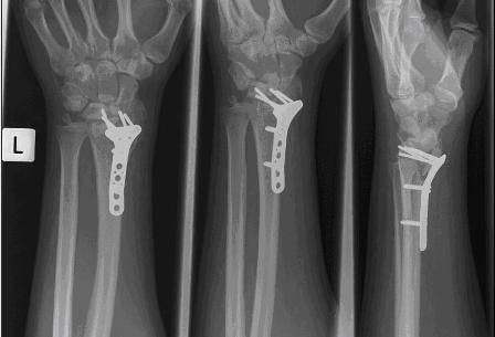 wrist2.JPG