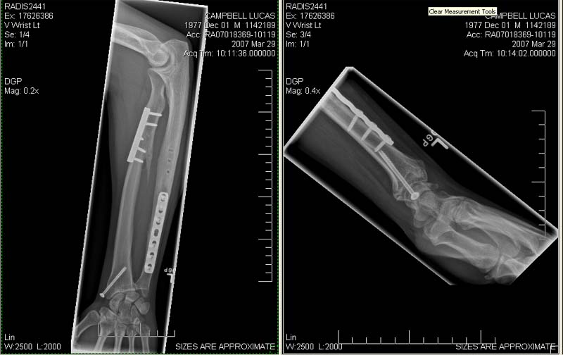 Ouch arm.jpg